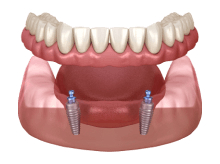 Implant Supported Denture