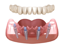 Full Arch Dental Implant